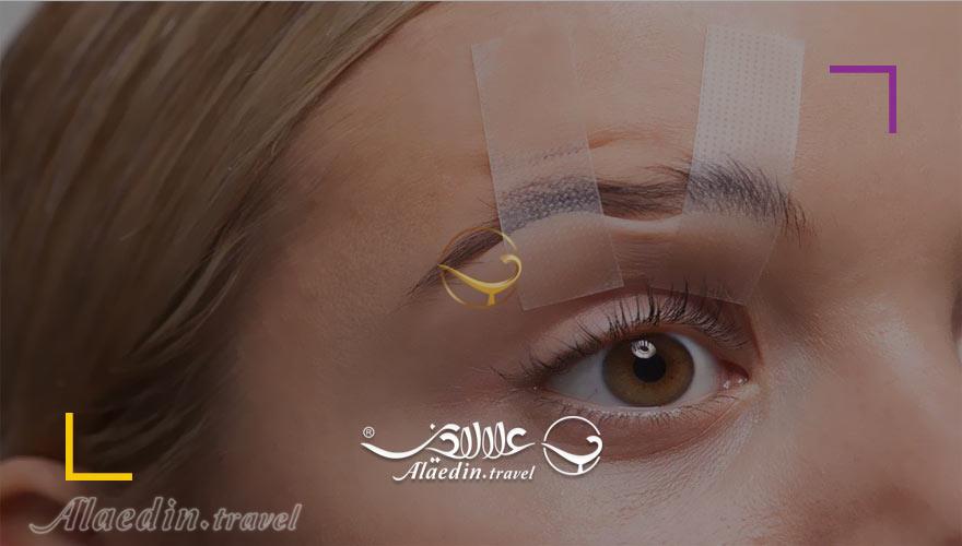 جراحی پلک در ایران | علاءالدین تراول