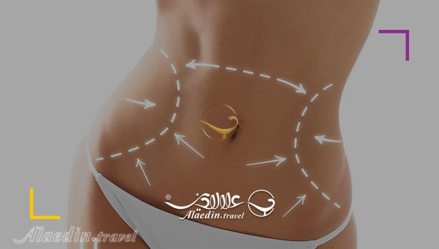 ابدومینوپلاستی در ایران | علاءالدین تراول